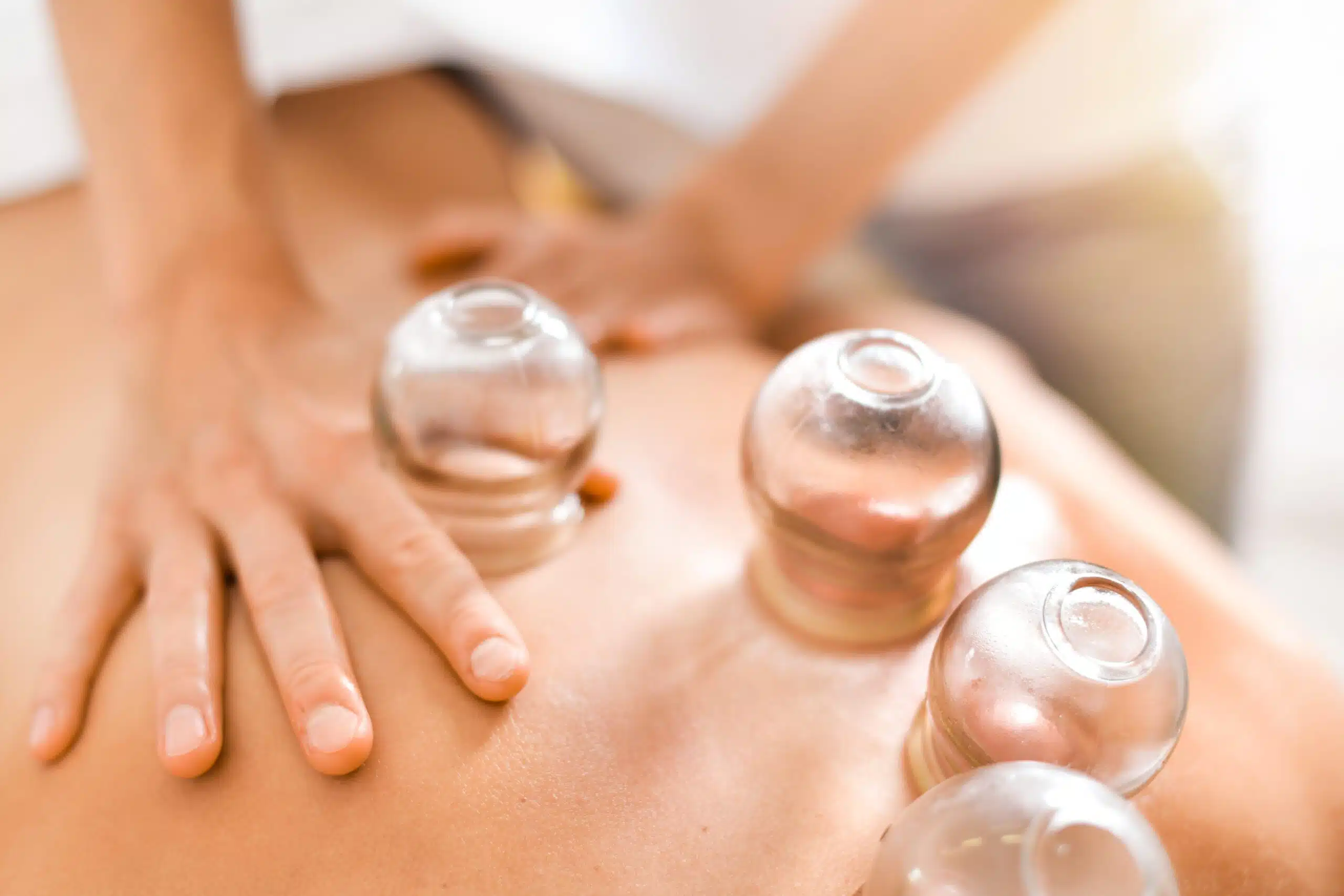 Cupping therapy at Fields of Qi