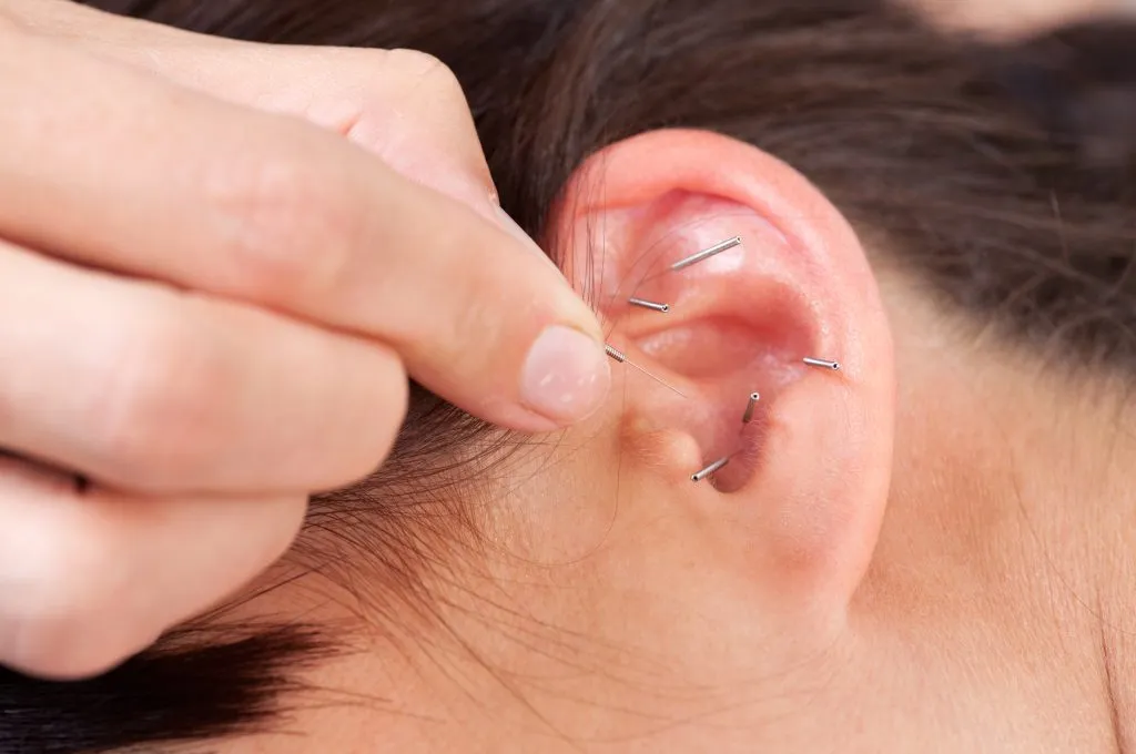 Licensed acupuncturist performing auricular acupuncture by gently placing needles in a client’s ear at Fields of Qi clinic.