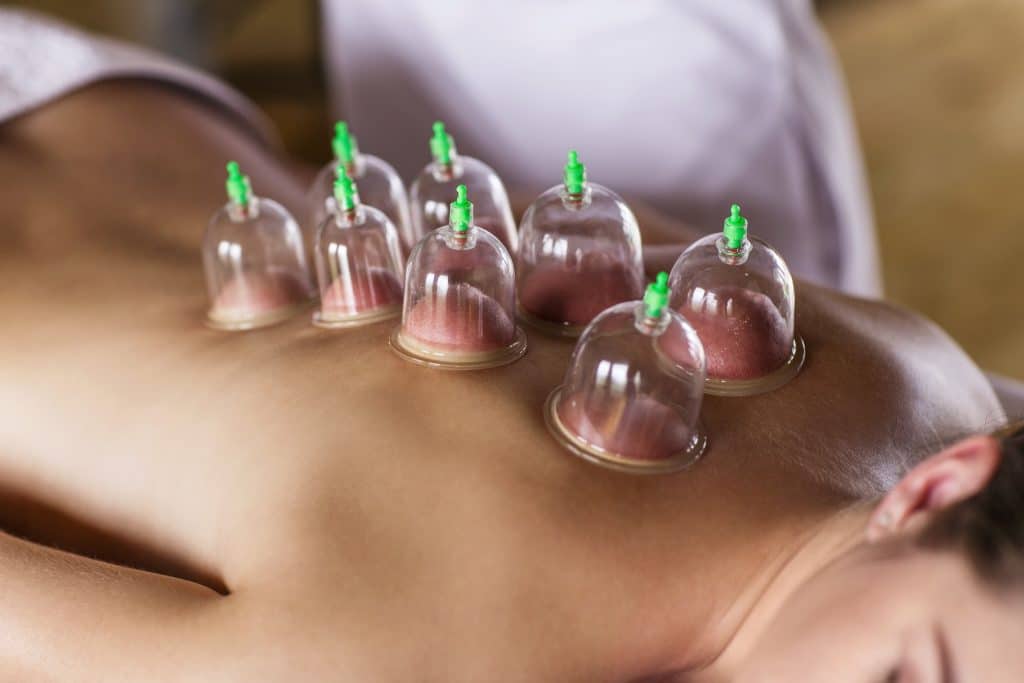 Cupping therapy treatment on woman’s back for pain relief, muscle recovery, and holistic wellness at Fields of Qi acupuncture clinic.