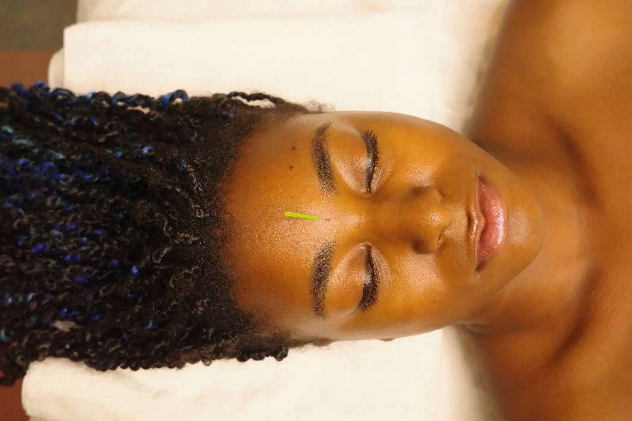 Licensed acupuncturist gently inserting a needle at the Yintang point between the eyebrows for relaxation and stress relief at Fields of Qi.